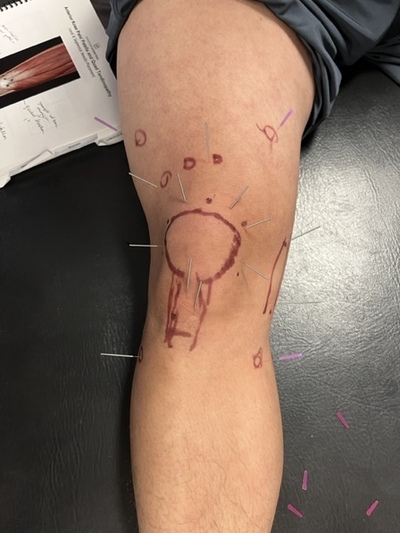 Link to: https://myrosechiro.com/dry-needling-therapy-aurora